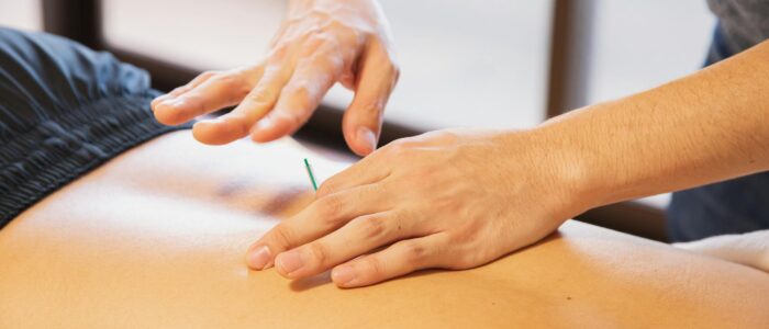 Photo by Ryutaro Tsukata Crop anonymous male doctor putting needles on back during acupuncture therapy session in rehabilitation salon